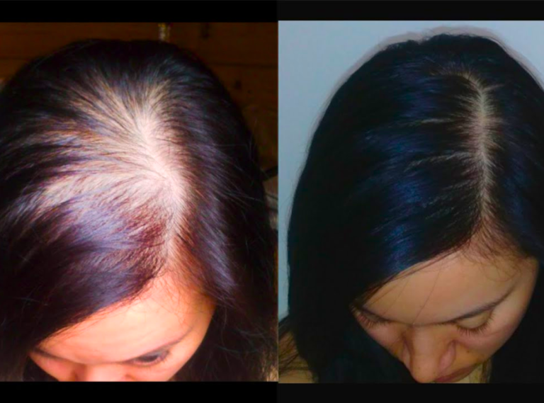 menopause hair fall