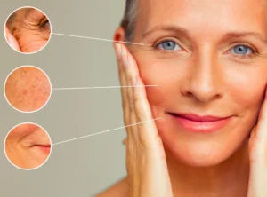 Menopause and Wrinkles