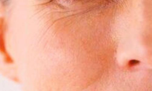 wrinkles on the face